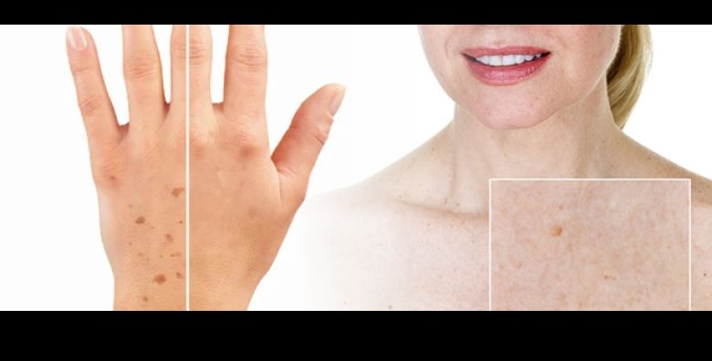 Uklonite fleke i mrlje na sakama ili dekolteu uz 3D IPL Alpha tretman u Beauty Centar Kozlinger Zagreb Vidljivi rezultati vec nakon prvog dolaska najnovijom tehnologijom 