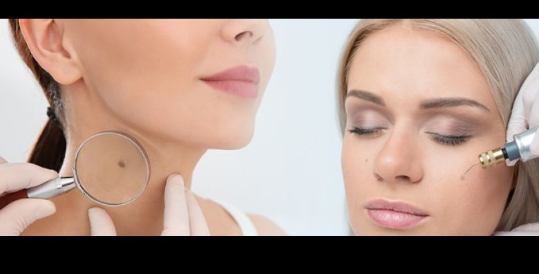 Inovativnim tretmanom PLASMA PENA uklonite madez velicine do 1 cm u ordinaciji dr med Danijela Sebe u Zagrebu za samo 35 eura 