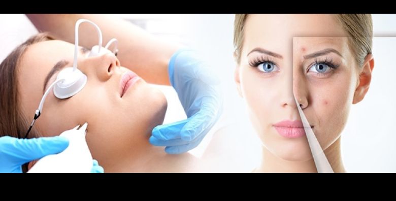 Zauvijek mladolika koza lica bez pora i bora i oziljaka od akni Da moguce je Lasersko uklanjanje akni ili fotopomladjivanje u Studiu Melanis u Zagrebu uz 55posto POPUSTA 