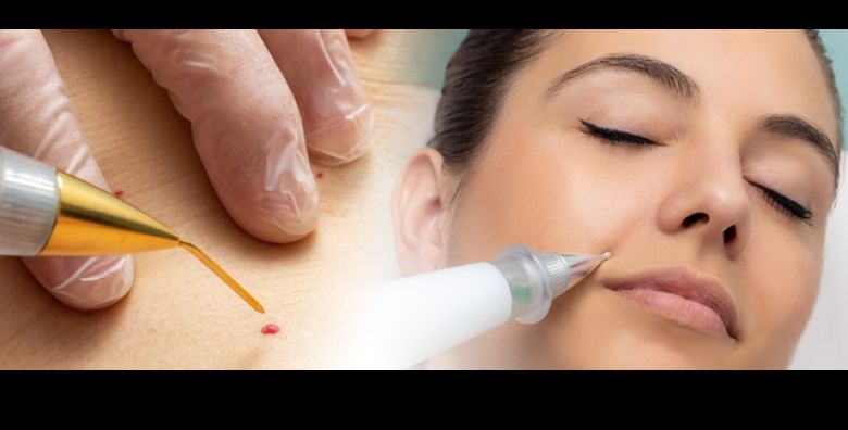 Ako Vam smetaju neugodne kozne izrasline na kozi PATRIZIA beauty salon iz Zagreba donosi odlicnu ponudu za uklanjanje bradavica fibroma keratoza i sitnih nesavrsenosti na kozi PLASMA PENOM 