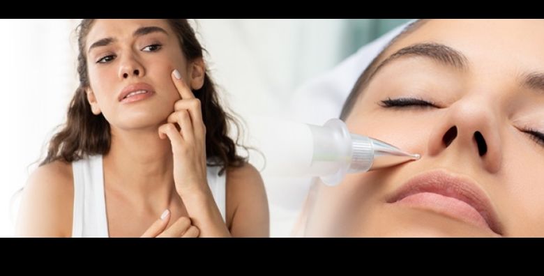 Neugodne bradavice fibrome i keratoze uklonite bezbolno uz PLASMA PEN u Beauty centru Kozlinger u Zagrebu  uklanjanje 1 ili do 10 izraslina 