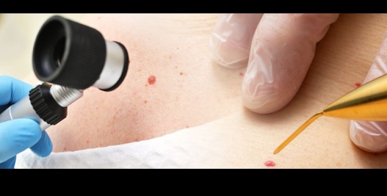 ZAGREB: UKLANJANJE BRADAVICA OZONOM i tretman BIOLASEROM u Studiju ljepote Manuela Rijesite se nepravilnosti BEZBOLNO i sigurno za samo 20 € Iskoristite vrhunsku metodu uz BRZ OPORAVAK koze 