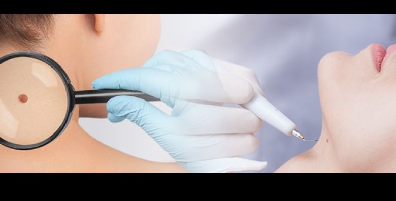  ZAGREB Poliklinika VitalArt donosi odlicnu ponudu za NEKIRURSKO uklanjanje do 3 madeza bradavice ili lipoma inovativnim aparatom Plasmage uz pregled i lokalnu anesteziju 