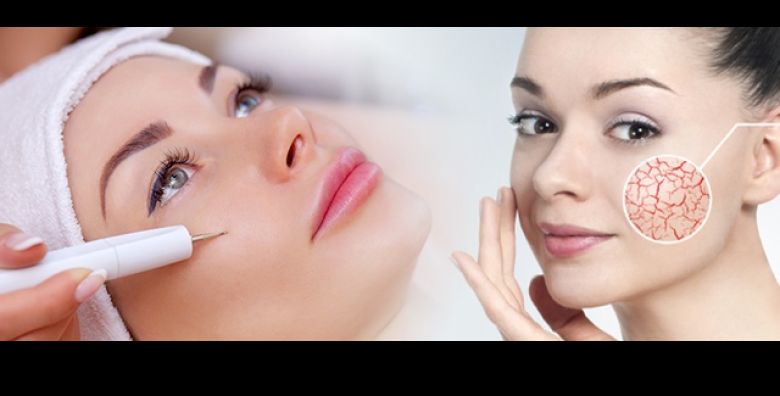 Uklonite nezeljene KAPILARE s lica u Beauty Centru Kozlinger u Zagrebu  BEZBOLNO RJESENJE estetskog problema vidljivih kapilara uz STRUCNJAKE 