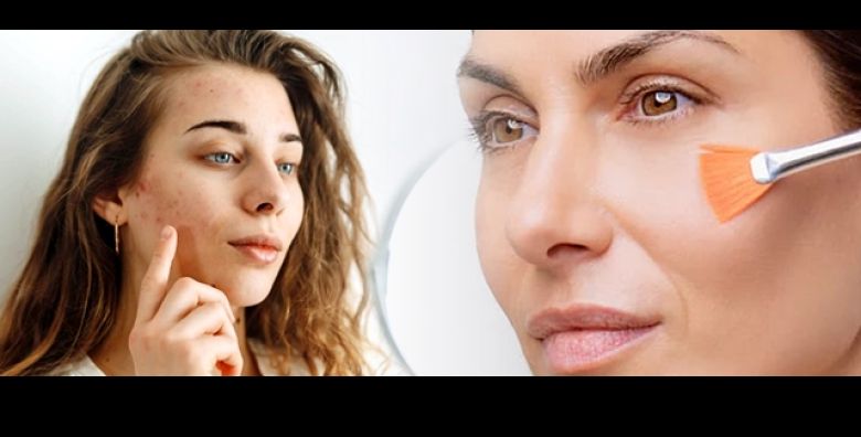 Ugrabi ACNE RESET paket za cisto lice bez upala Salon Val Beauté Zagreb nudi napredni tretman za DUBINSKO ciscenje koze: mehanicko ciscenje mocan Mesoestetic kemijski peeling i pregled 