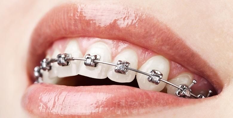 APARATIC ZA ZUBE  postavljanje svi pregledi tijekom nosenja  ciscenje i poliranje zubi kod skidanja aparatica