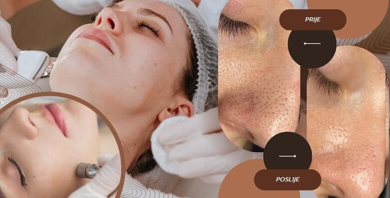 Ultrazvucno ciscenje lica spatulom uz njegu lica pilingom maskom i masazom te dijamantna mikrodermoabrazija u Glam Lab u