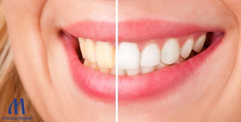 Rijesite se nezeljenih mrlja i uzivajte u dugotrajno blistavom osmijehu uz ciscenje kamenca pjeskarenje i poliranje zubi  pregled u Ordinaciji Matijevic