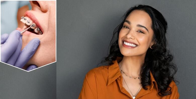 Fiksni aparatic za jednu celjust uz ukljucene sve preglede i kontrole u Specijalistickoj ordinaciji dentalne medicine za ortodonciju Dinko Cotic