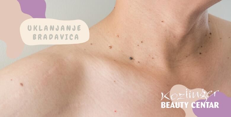 Bezbolno uklonite 1 ili do 10 bradavica fibroma i keratoza PLASMA PEN tretmanom u Beauty centru Kozlinger