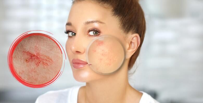 UKLANJANJE KAPILARA  do cistog i blistavog lica uz strucnjake s vise od 20 godina iskustva u Beauty centru Kozlinger