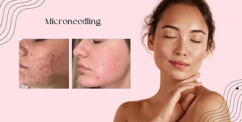 Smanjite mrlje bore i oziljke uz MICRONEEDLING i KEMIJSKI PILING za blistavu kozu ujednaceniji ten i regeneraciju u Studiju Bio klinik