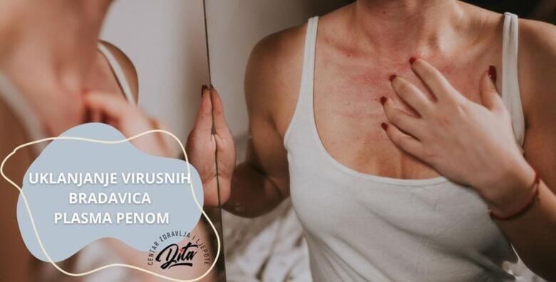 Uklanjanje neogranicenog broja virusnih bradavica bezbolnim PLASMA PEN tretmanom u Centru zdravlja i ljepote Dita