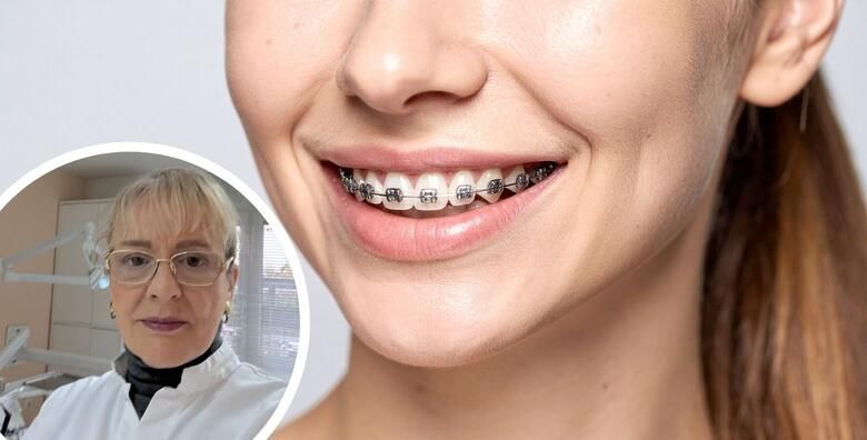 APARATIC ZA ZUBE  postavljanje svi pregledi tijekom nosenja  ciscenje i poliranje zubi kod skidanja aparatica