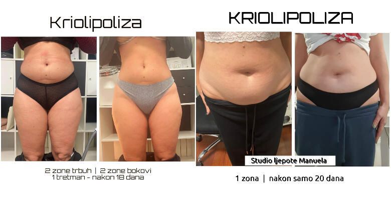 SVJETSKI HIT TRETMAN Najbolji tretman zamrzavanja masnih stanica CryocoolSculpting 360 ili 4D kojeg koriste svjetski poznate osobe u Studiju ljepote Manuela
