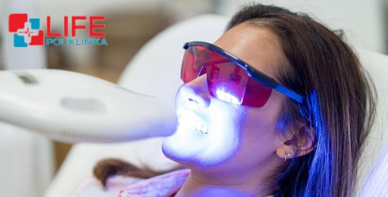 IZBJELJIVANJE ZUBI  izrada udlaga prema individualnim potrebama uz pregled i konzultacije strucnog tima Poliklinike Life i KUCNI set za izbjeljivanje