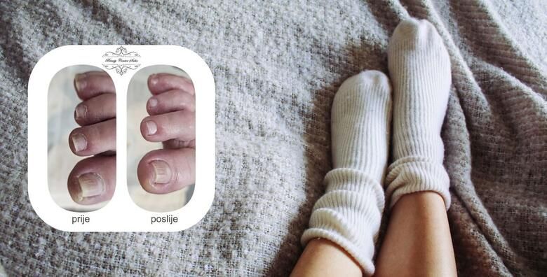 Medicinska pedikura s trajnim lakom  uklanjanje natisaka kurjih ociju i uraslih noktiju za zdravlje stopala u Beauty centru Salus