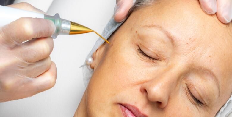 Uklanjanje bradavice keratoze ili fibroma inovativnim tretmanom PLASMA PEN  najefikasniji nacin uklanjanja bradavica u Bio klinik kozmetickom salonu