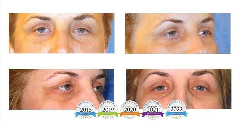 Blefaroplastika  pomladite se uz zahvat na oba oka i ukljucenu anesteziju i kontrolu nakon zahvata uz NAJdoktora Bojana Ignatovskog u Poliklinici Arcadia