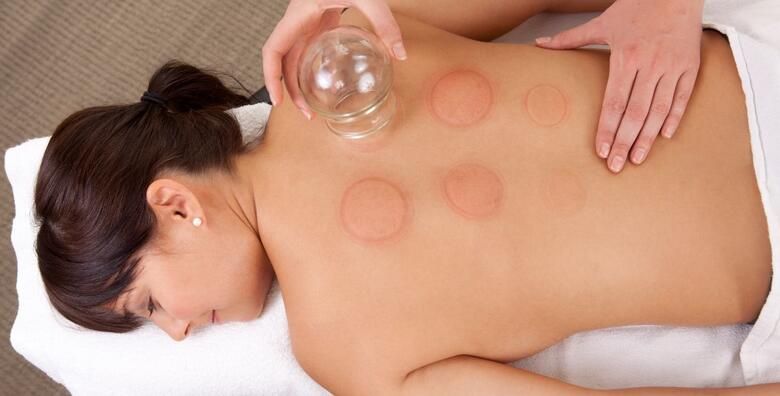 5 cupping tretmana 30 60 min u Aura Beauty Studiju